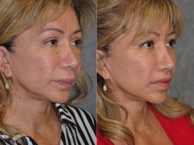 Corrective Modified Upper Lip Lift and Lip Border Revision - Right Side