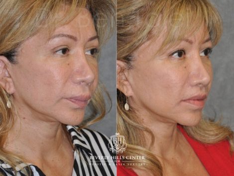 Corrective Modified Upper Lip Lift and Lip Border Revision - Right Side