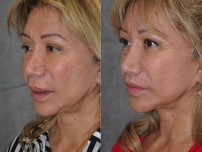 Corrective Modified Upper Lip Lift and Lip Border Revision - Left Side