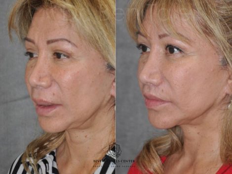 Corrective Modified Upper Lip Lift and Lip Border Revision - Left Side