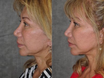 Corrective Modified Upper Lip Lift and Lip Border Revision - Left Side