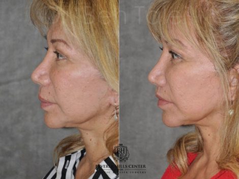 Corrective Modified Upper Lip Lift and Lip Border Revision - Left Side