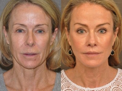 AuraLyft, BrowLift, Profound, Lip Lift – Front