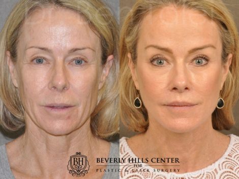AuraLyft, BrowLift, Profound, Lip Lift - Front