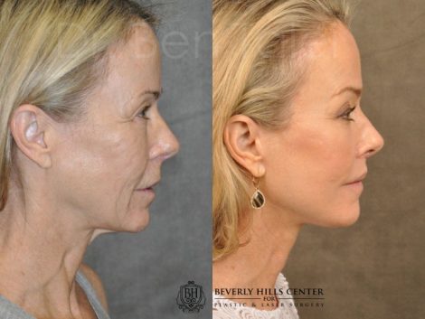 AuraLyft, BrowLift, Profound, Lip Lift - Right Side