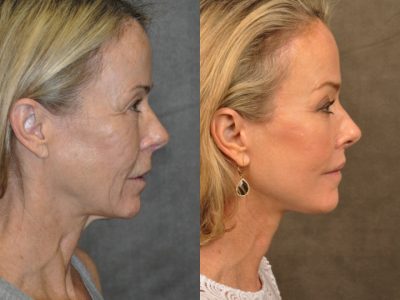AuraLyft, BrowLift, Profound, Lip Lift – Right Side