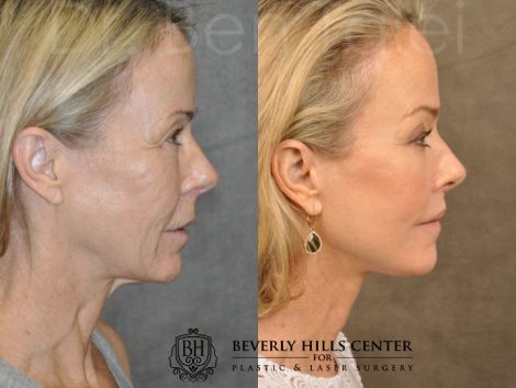 AuraLyft, BrowLift, Profound, Lip Lift - Right Side