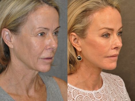 AuraLyft, BrowLift, Profound, Lip Lift – Right Side