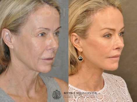 AuraLyft, BrowLift, Profound, Lip Lift - Right Side