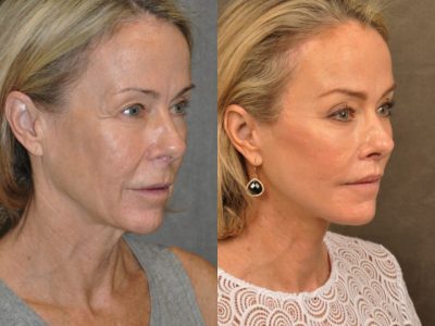 AuraLyft, BrowLift, Profound, Lip Lift – Right Side