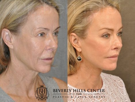 AuraLyft, BrowLift, Profound, Lip Lift - Right Side