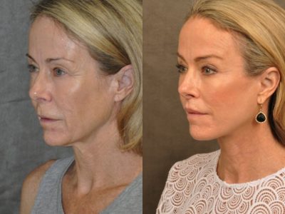 AuraLyft, BrowLift, Profound, Lip Lift – Left Side