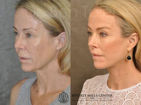 AuraLyft, BrowLift, Profound, Lip Lift - Left Side