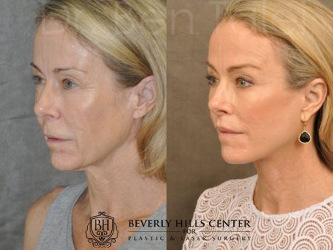 AuraLyft, BrowLift, Profound, Lip Lift - Left Side