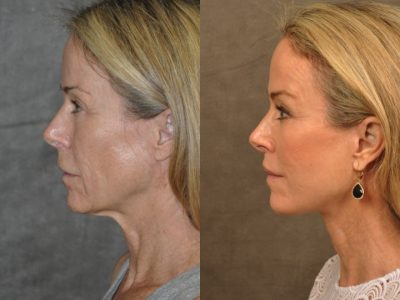 AuraLyft, BrowLift, Profound, Lip Lift – Left Side