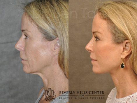 AuraLyft, BrowLift, Profound, Lip Lift - Left Side