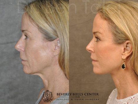 AuraLyft, BrowLift, Profound, Lip Lift - Left Side