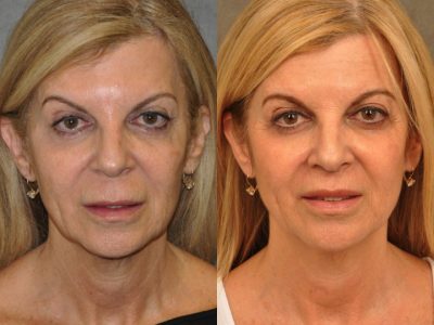 Modified Upper Lip Lift – Front