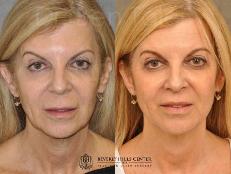 Modified Upper Lip Lift - Front