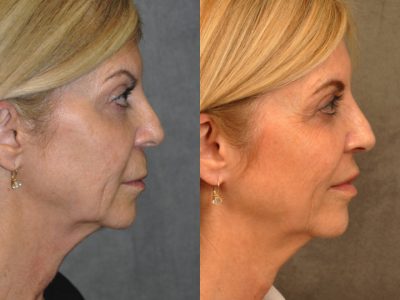Modified Upper Lip Lift – Right Side