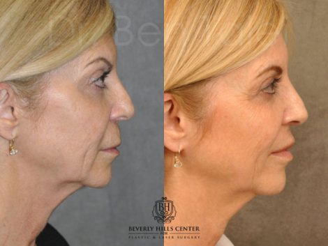 Modified Upper Lip Lift - Right Side
