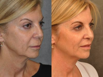 Modified Upper Lip Lift – Right Side