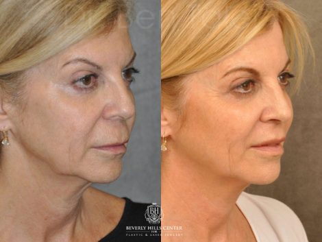 Modified Upper Lip Lift - Right Side