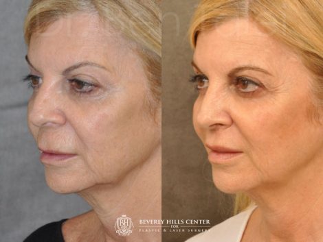 Modified Upper Lip Lift - Left Side