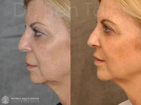 Modified Upper Lip Lift - Left Side