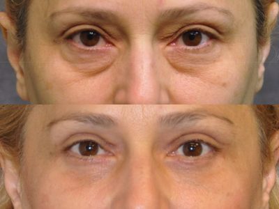 Upper & Lower Eyelid Lift - Front