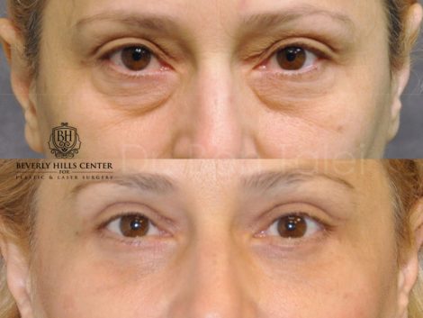 Upper & Lower Eyelid Lift - Front