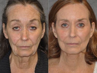Painless AuraLyft with Upper Eyelid Ptosis (Drooping) repair - Front