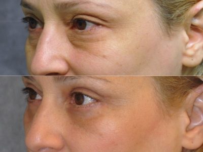 Upper & Lower Eyelid Lift - Left Side
