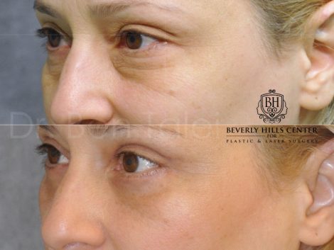 Upper & Lower Eyelid Lift - Left Side