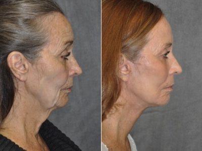 Painless AuraLyft with Upper Eyelid Ptosis (Drooping) repair - Right Side