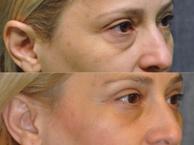 Upper & Lower Eyelid Lift - Right Side