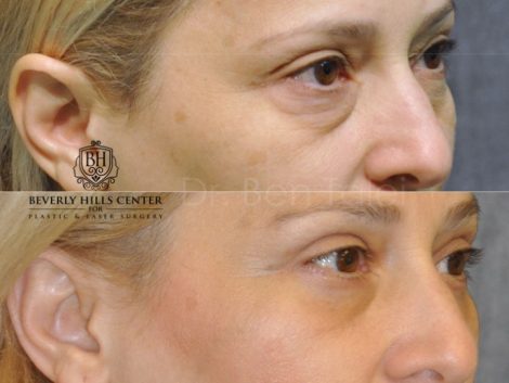 Upper & Lower Eyelid Lift - Right Side