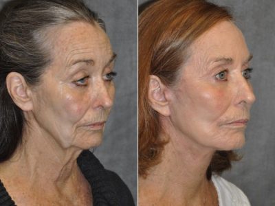 Painless AuraLyft with Upper Eyelid Ptosis (Drooping) repair - Right Side