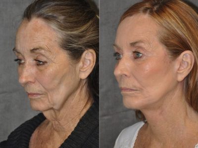 Painless AuraLyft with Upper Eyelid Ptosis (Drooping) repair - Left Side