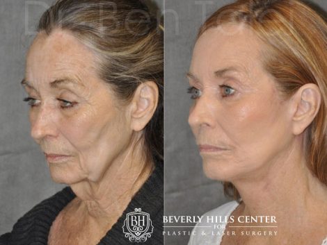 Painless AuraLyft with Upper Eyelid Ptosis (Drooping) repair - Left Side
