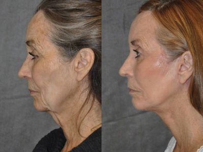Painless AuraLyft with Upper Eyelid Ptosis (Drooping) repair - Left Side