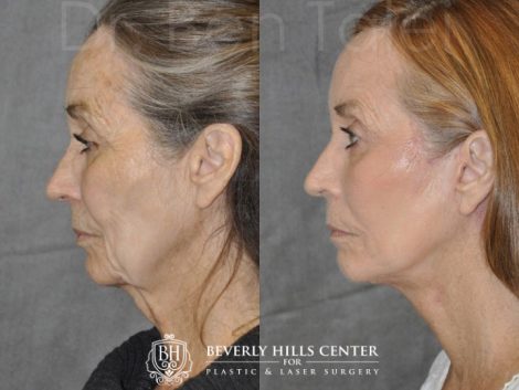 Painless AuraLyft with Upper Eyelid Ptosis (Drooping) repair - Left Side