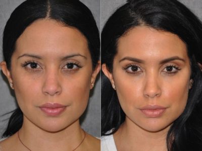 Lip, Cheek and Eye Enhancement - Front