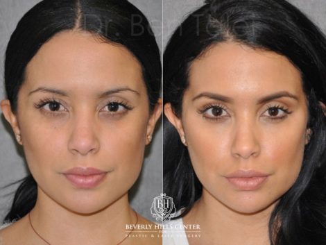 Lip, Cheek and Eye Enhancement - Front