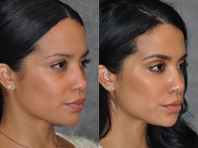 Lip, Cheek and Eye Enhancement - Left Side