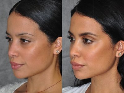 Lip, Cheek and Eye Enhancement - Right Side