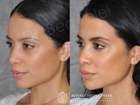 Lip, Cheek and Eye Enhancement - Right Side