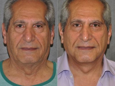 Lower Eyelid Tightening - Front