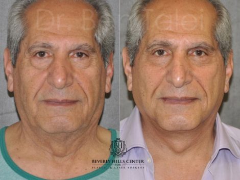 Lower Eyelid Tightening - Front