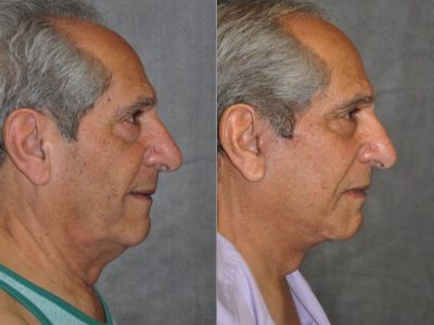 Lower Eyelid Tightening - Right Side
